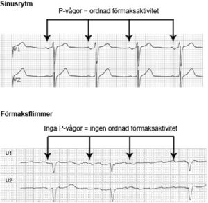 Sinusrytm